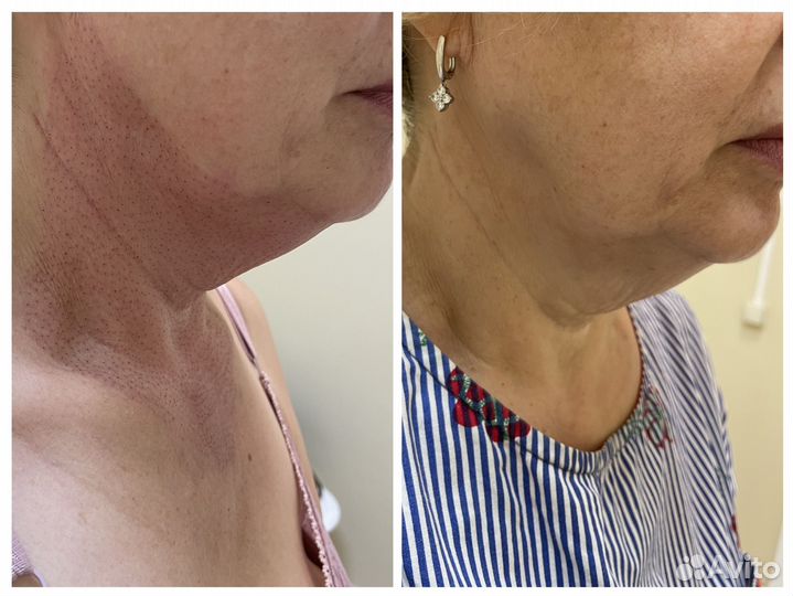 Омоложение кожи горячей плазмой, подтяжка кожи