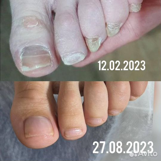 Обработка стоп и ногтей у Вас дома