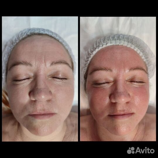 Массаж лица