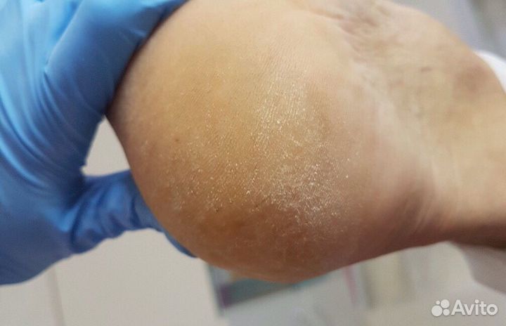 Педикюр любой сложности с подологическим уклоном