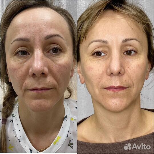 Косметолог без иголок