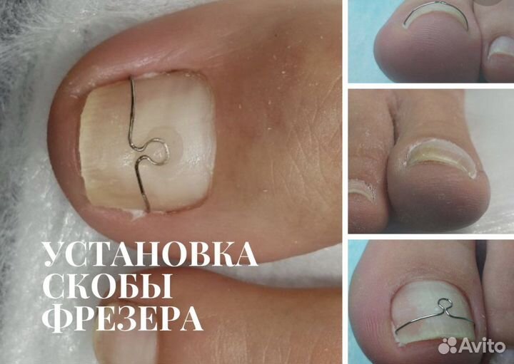 Услуги подолога- коррекция вросших ногтей
