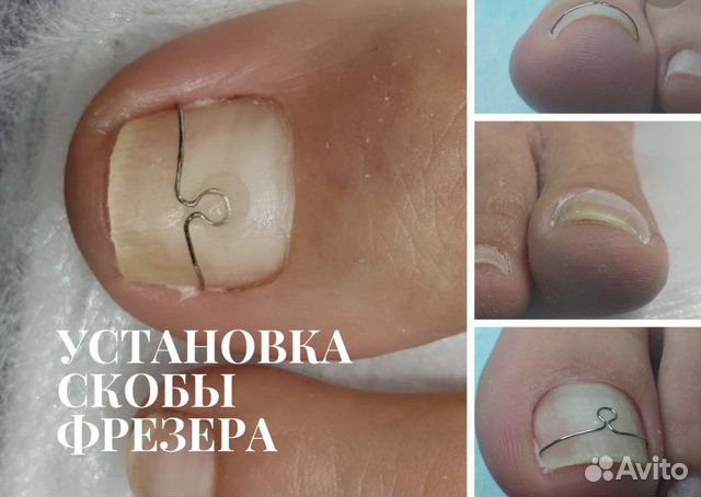 Услуги подолога- коррекция вросших ногтей