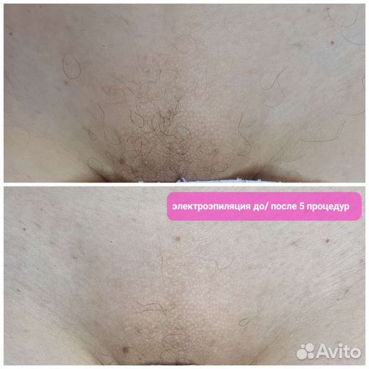 Электроэпиляция