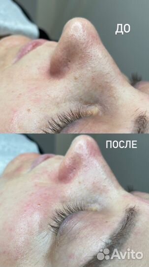 Желтый пилинг