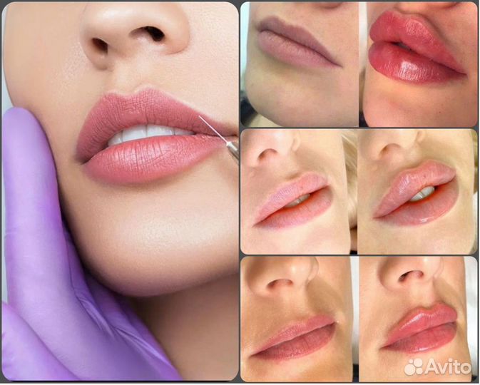 Увеличение губ Контурная пластика фулфейс