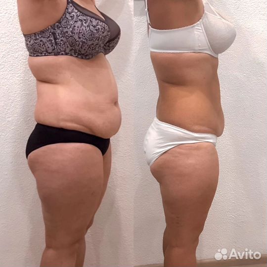 Аппаратный массаж, карамельная липосакци