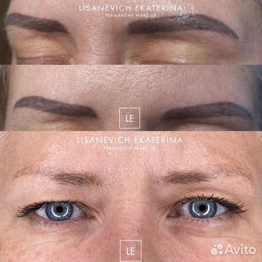 Удаление тату и татуажа лазером, ремувером