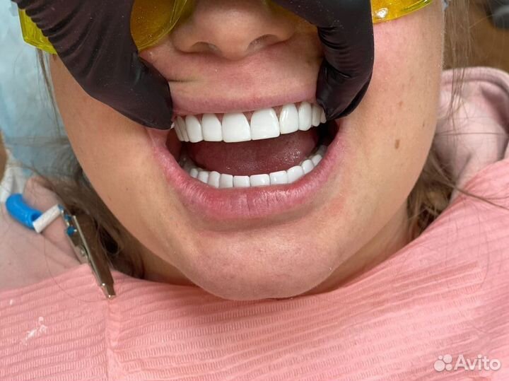 Зубной техник Виниры Коронки