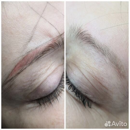 Удаление татуажа, тату