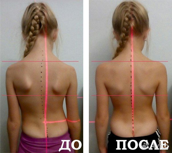 FDM Массаж лучше чем Мануальный терапевт