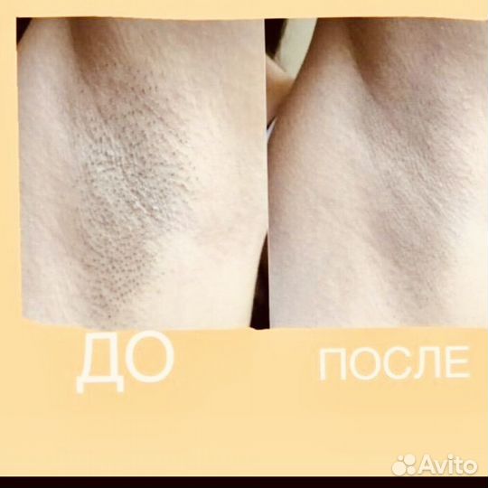 Элос-эпиляция: глубокое бикини