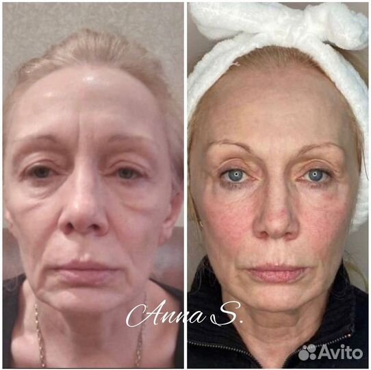 Холодная плазма, подтяжка лица, шеи и век