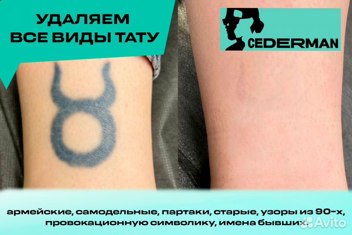 Удаление тату
