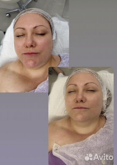 Консультация косметолога