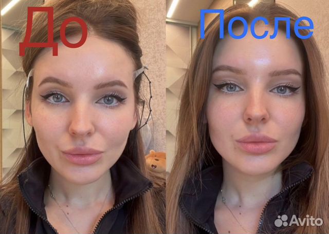 Тейпы от нависших век и подбородка