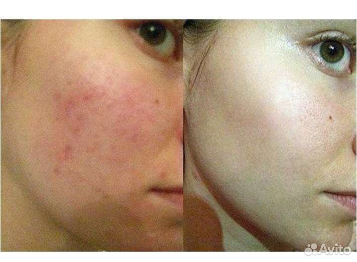 Болтушка от прыщей