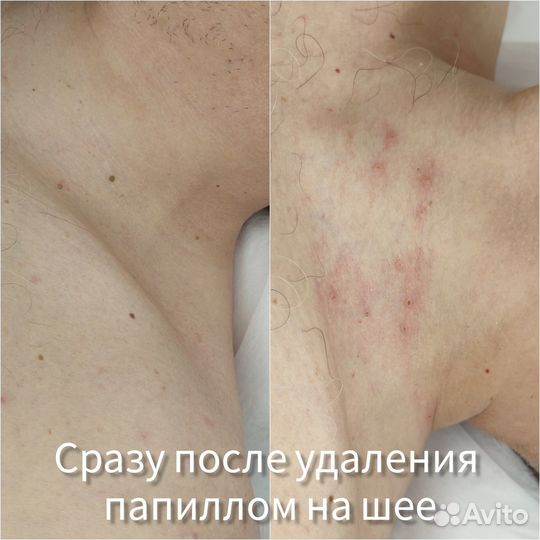 Удаление папиллом
