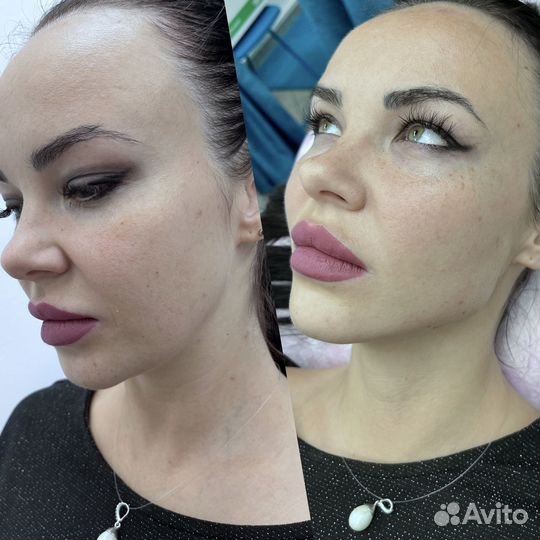 Лифтинг лица
