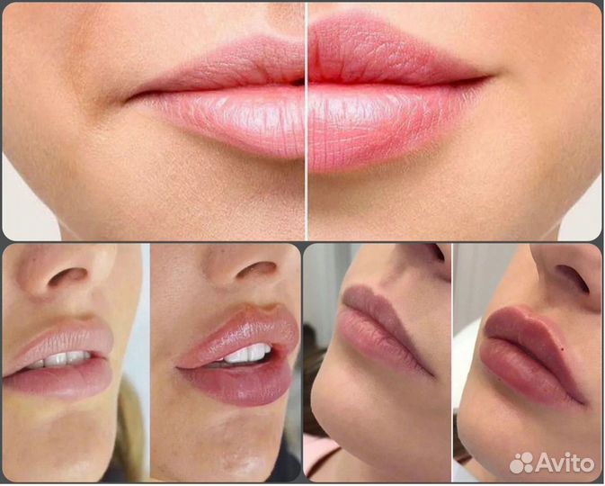 Увеличение губ Контурная пластика фулфейс