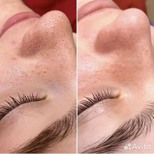 Косметолог чистка лица