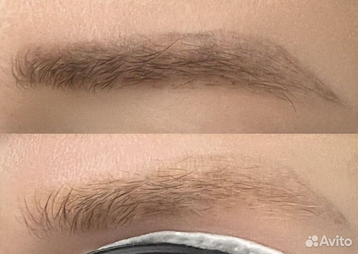 Удаление татуажа и татуировок