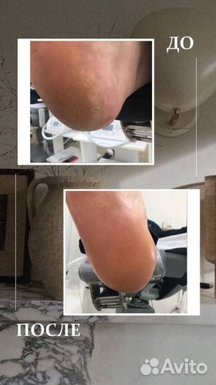 Аппаратный педикюр