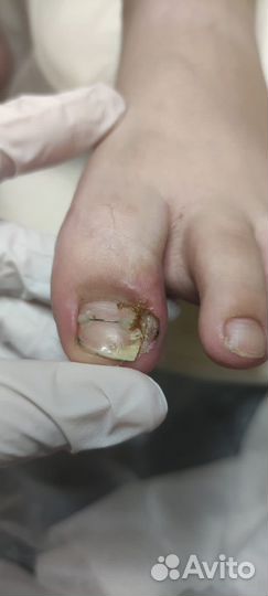 Бесплатная консультация подолога