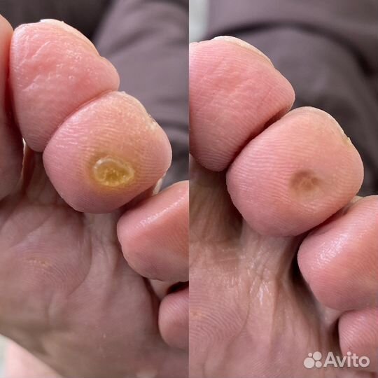 Подолог. Вросшие ногти, трещины, мозоли