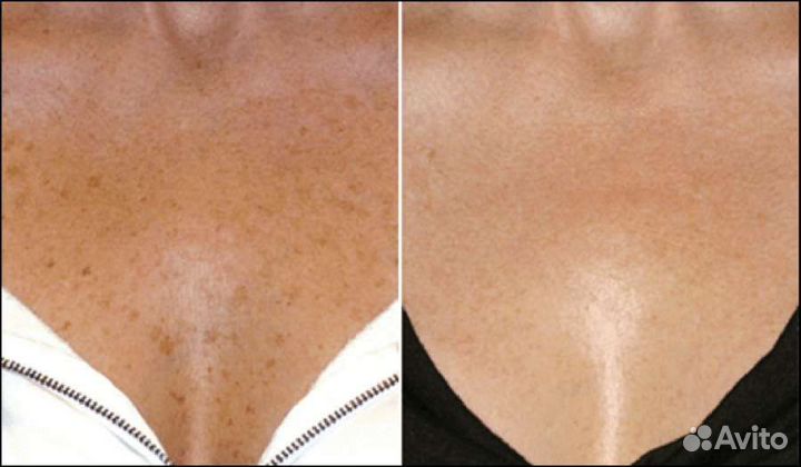 Отбеливание кожи