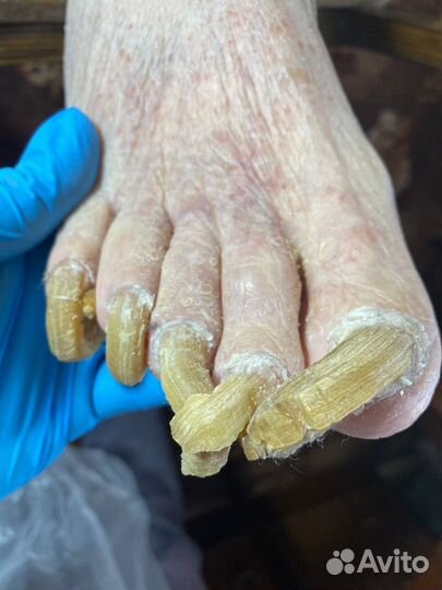 Сложный медицинский педикюр с выездом на дом