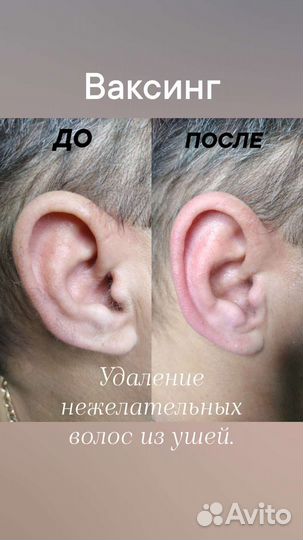 Шугаринг: подмышки