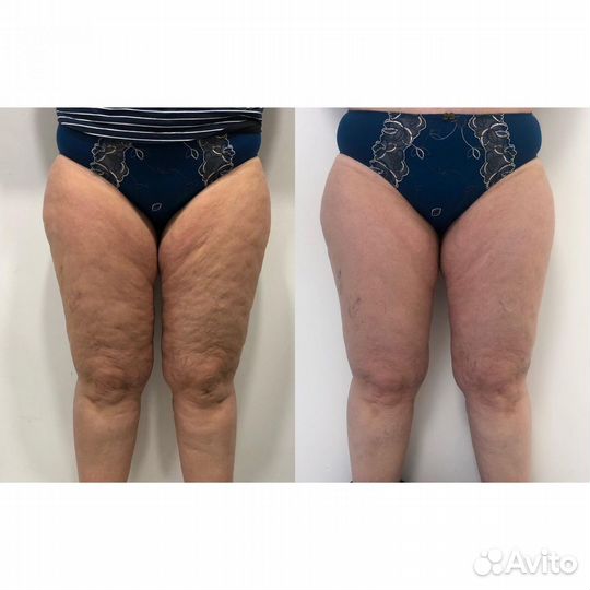 Криолиполиз