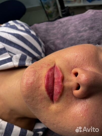 Модель на увеличение губ