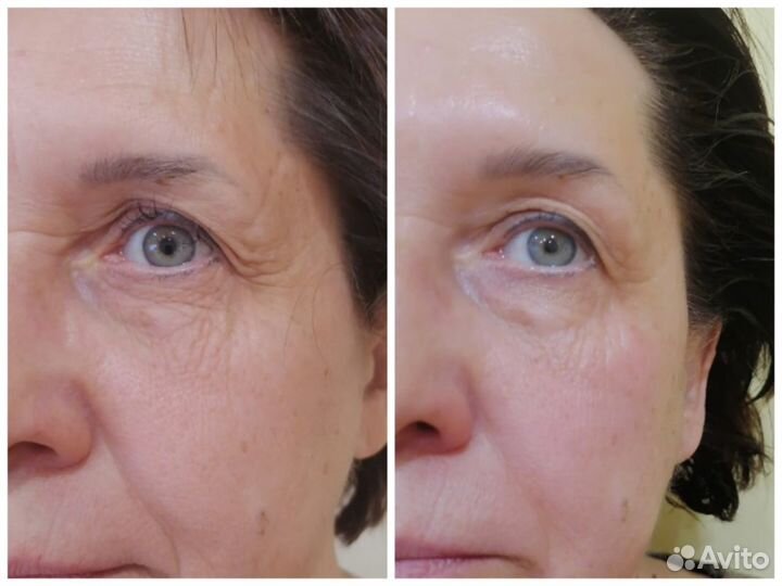 Массаж лица скульптурно-буккальный и антицеллюлитн