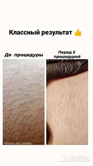 Электроэпиляция г. Буинск