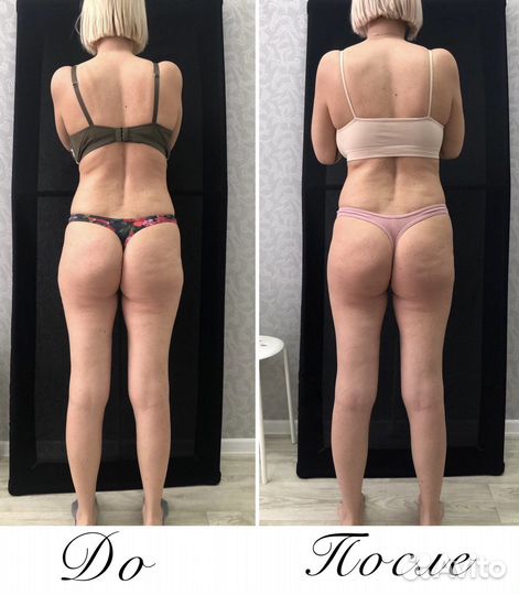 Массаж. Мадеротерапия.Ручная Липопластика