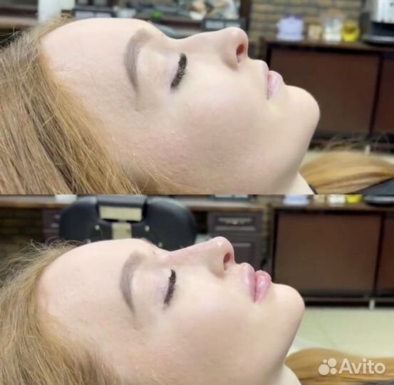 Коррекция формы носа, ринопластика без операции