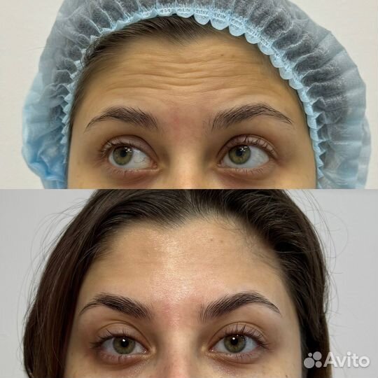 Ботулинотерапия