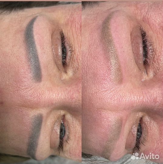 Удаление татуажа