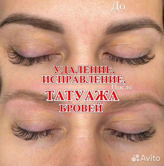 Удаление и исправление татуажа бровей