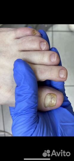 Педикюр подолог