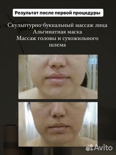 Буккальный массаж лица