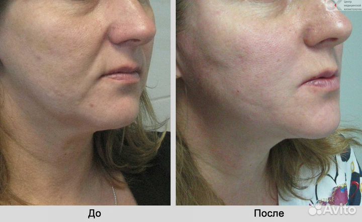 Микроигольчатый RF лифтинг