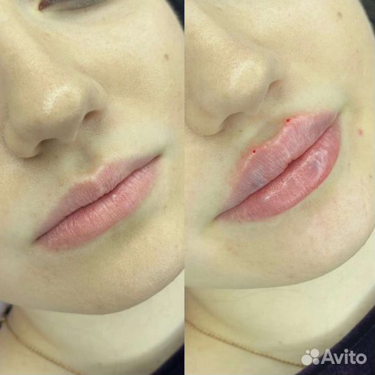 Увеличение губ