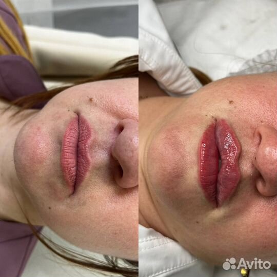 Увеличение губ контурная пластика губ косметолог