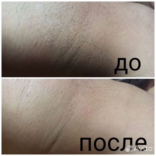 Шугаринг. Воск