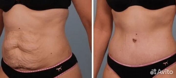 Липосакция без операции