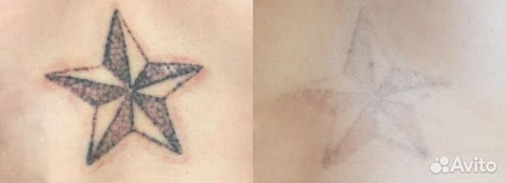 Лазерное удаление тату и татуажа