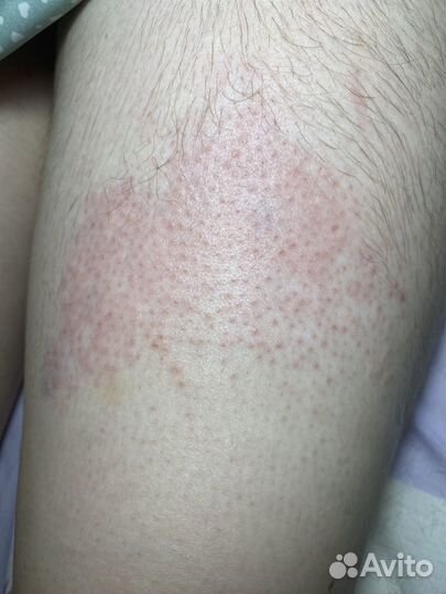 Электроэпиляция